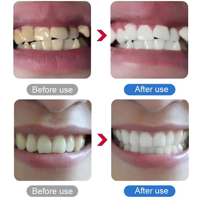 🦷🔥Bargain Alert ￡9.99!!⚡Electric Ultrasonic Dental Scaler | Remove Tartar & Plaque✨