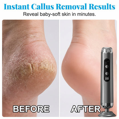 🥳2026 HOT SALE🥳💞50K+ SOLD!🏖️👍 50% OFF! 27,000 RPM Electric Foot Renewal – 5 speeds, disposable pads. No scrubbing, salon smooth at home. 🦶✨